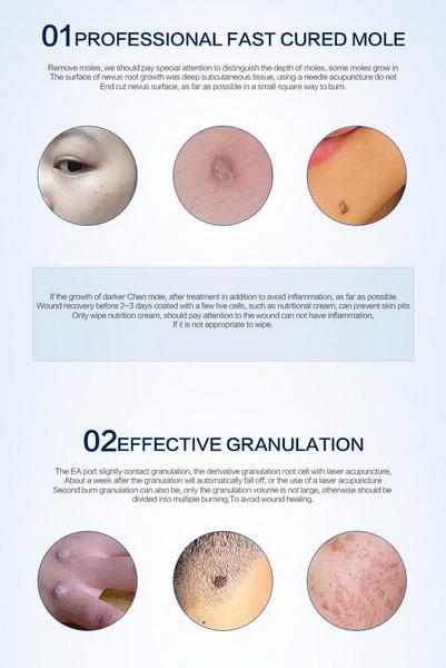 Amazing Laser Freckle & Mole Removal Pen